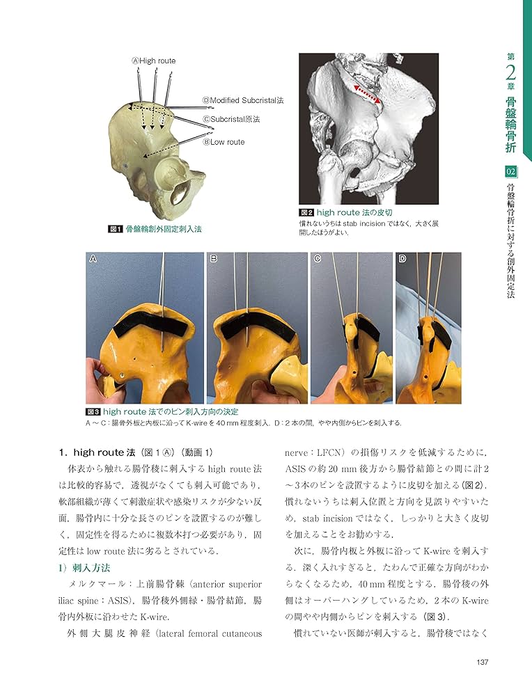 骨盤骨折: 寛骨臼骨折・骨盤輪骨折の手術手技 (整形外科SURGICAL TECHNIQUE BOOKS 9) 骨盤骨折: 寛骨臼骨折・骨盤輪骨折の手術手技 (整形外科SURGICAL
